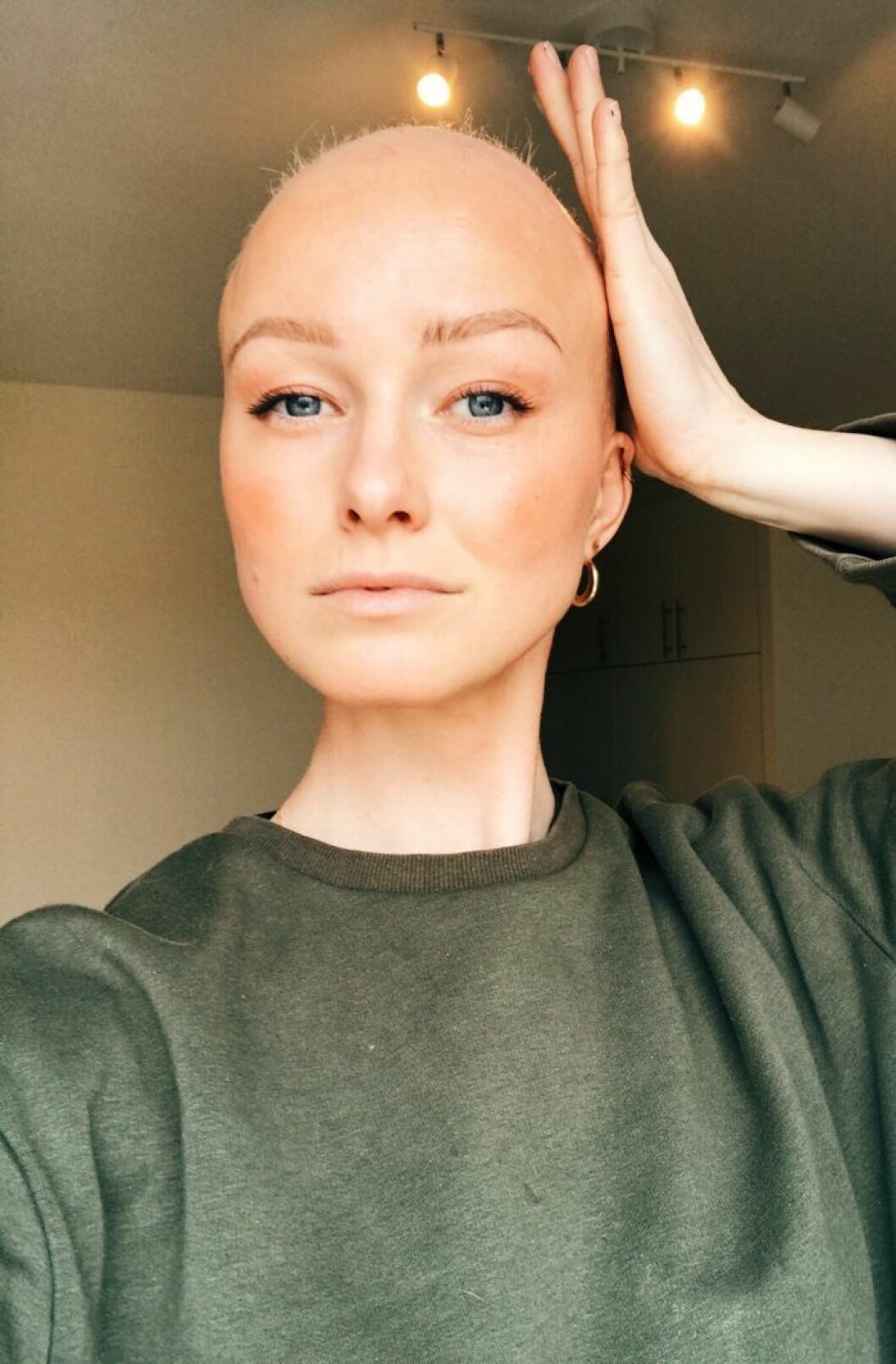 Efter mycket hopp om att håret skulle växa tillbaka valde Cecilia att raka av sitt hår. Foto: Privat Cecilia med rakart huvud.