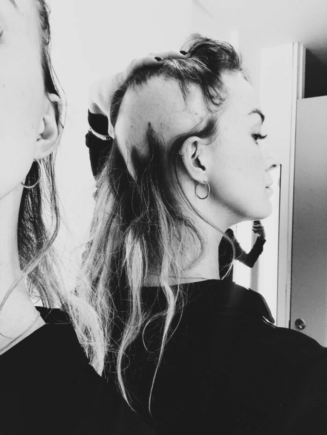 Cecilia Högvik har sjukdomen alopecia areata – vilket innebär håravfall. Foto: Privat Cecilia Högvik visar upp kala fläckar på huvudet.