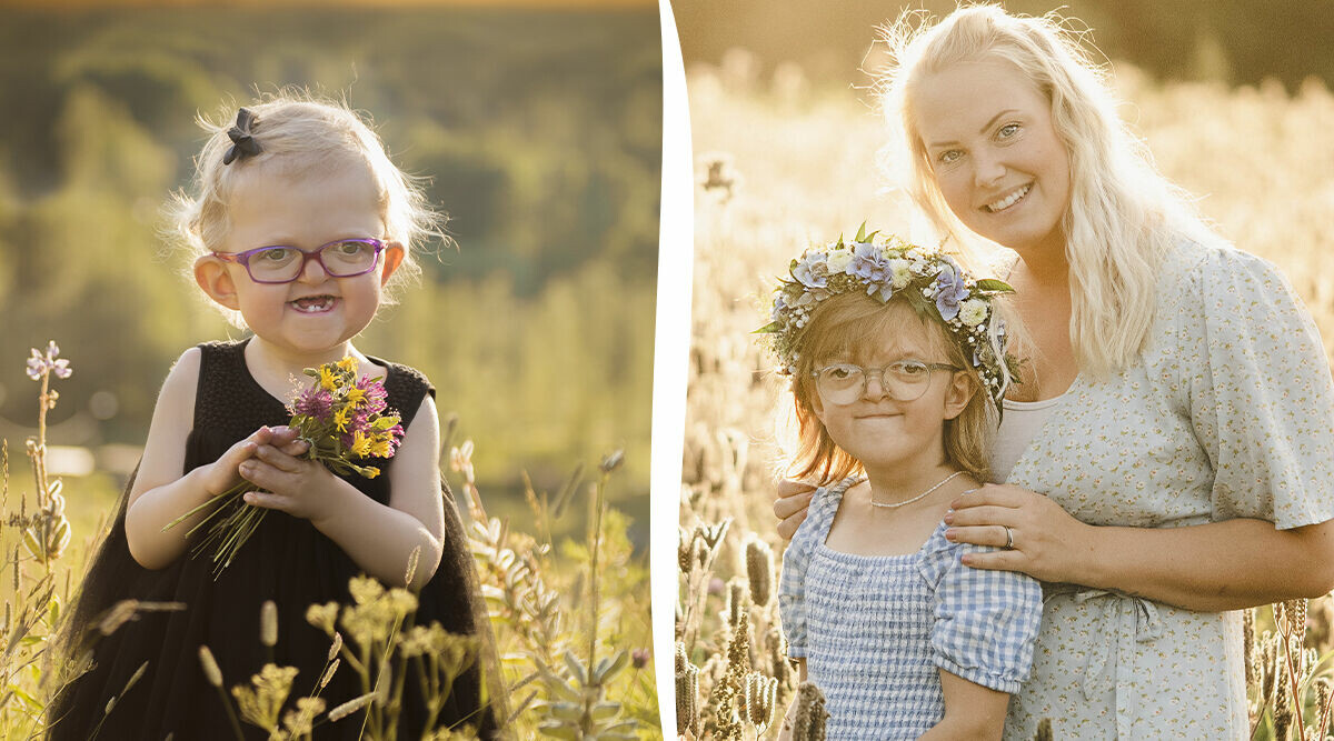 Minea föddes med Aperts syndrom: ”Ofta känner man sig hjälplös”