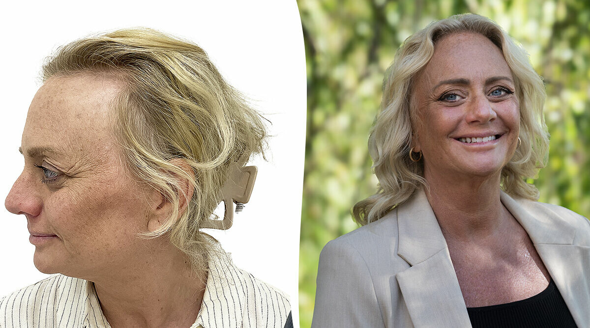 Malin gjorde hårtransplantation – så gick det till