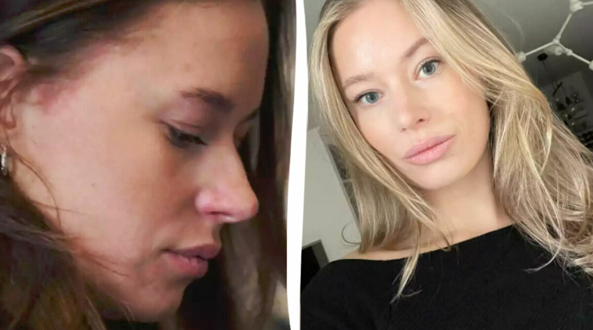 Budgetkrämen gör under för Annas torra hud och psoriasis: ”Bäst resultat”