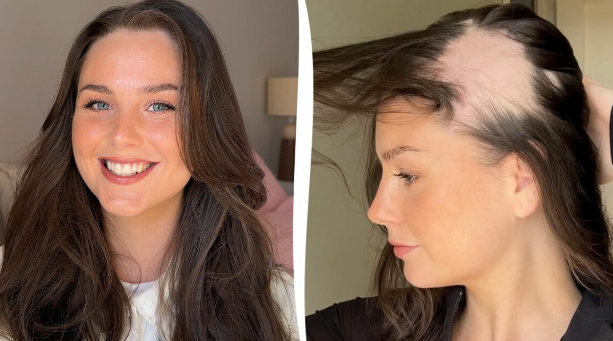 Jessica tappar sitt hår: ”Det finns inte så mycket att göra”