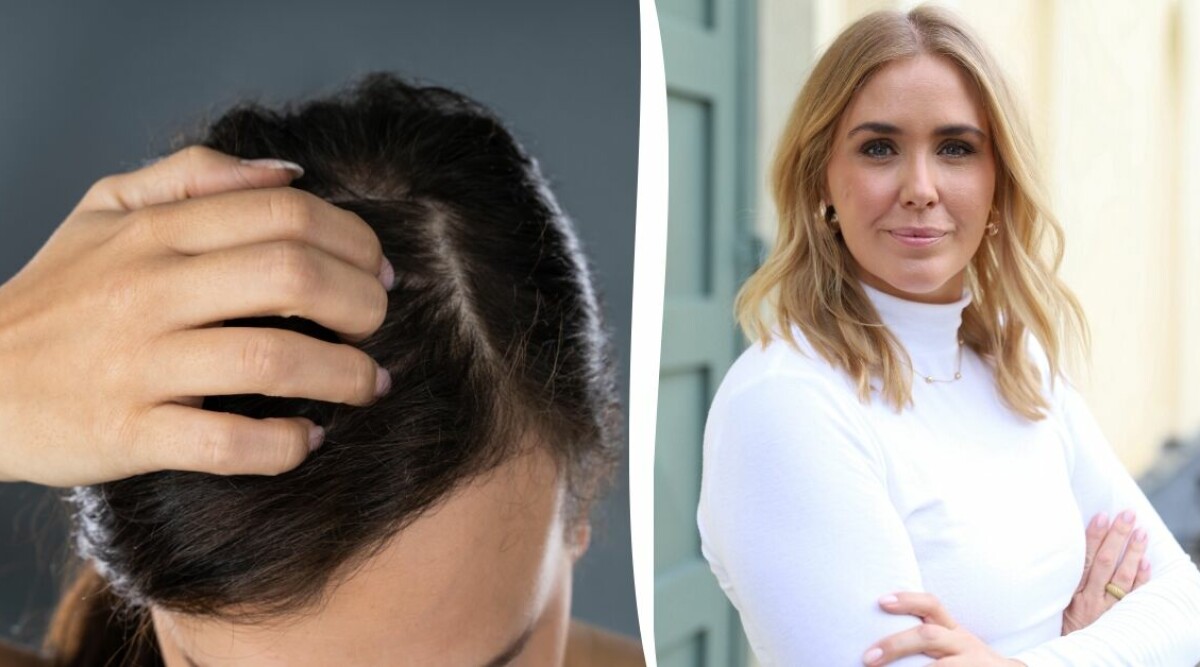 Frisören: Så här färgar du håret – även om du har psoriasis