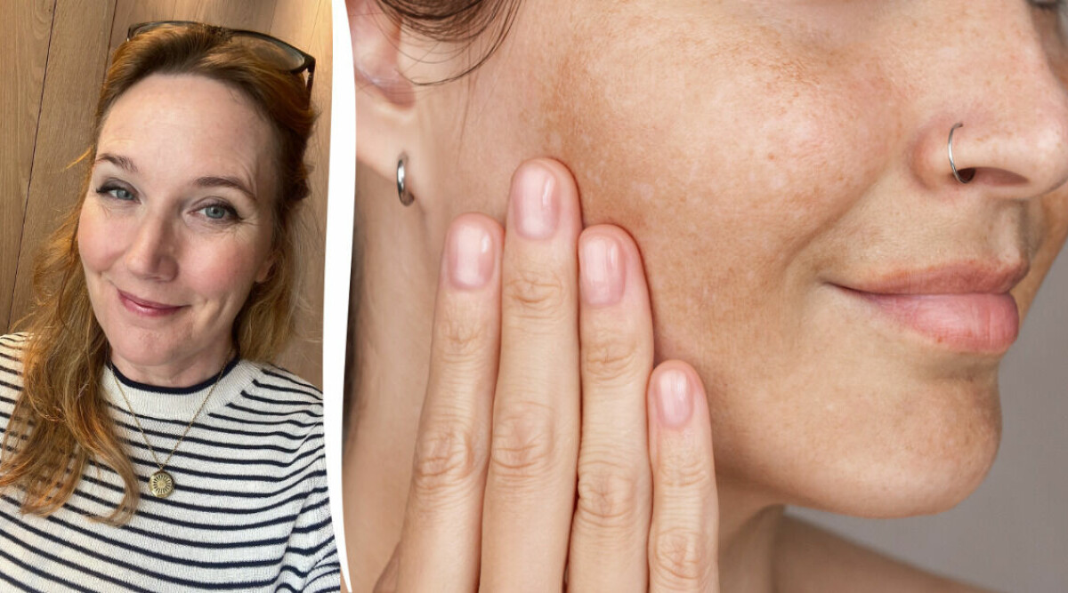 Skönhetsredaktörens tips: 5 produkter som får bort pigmentfläckar