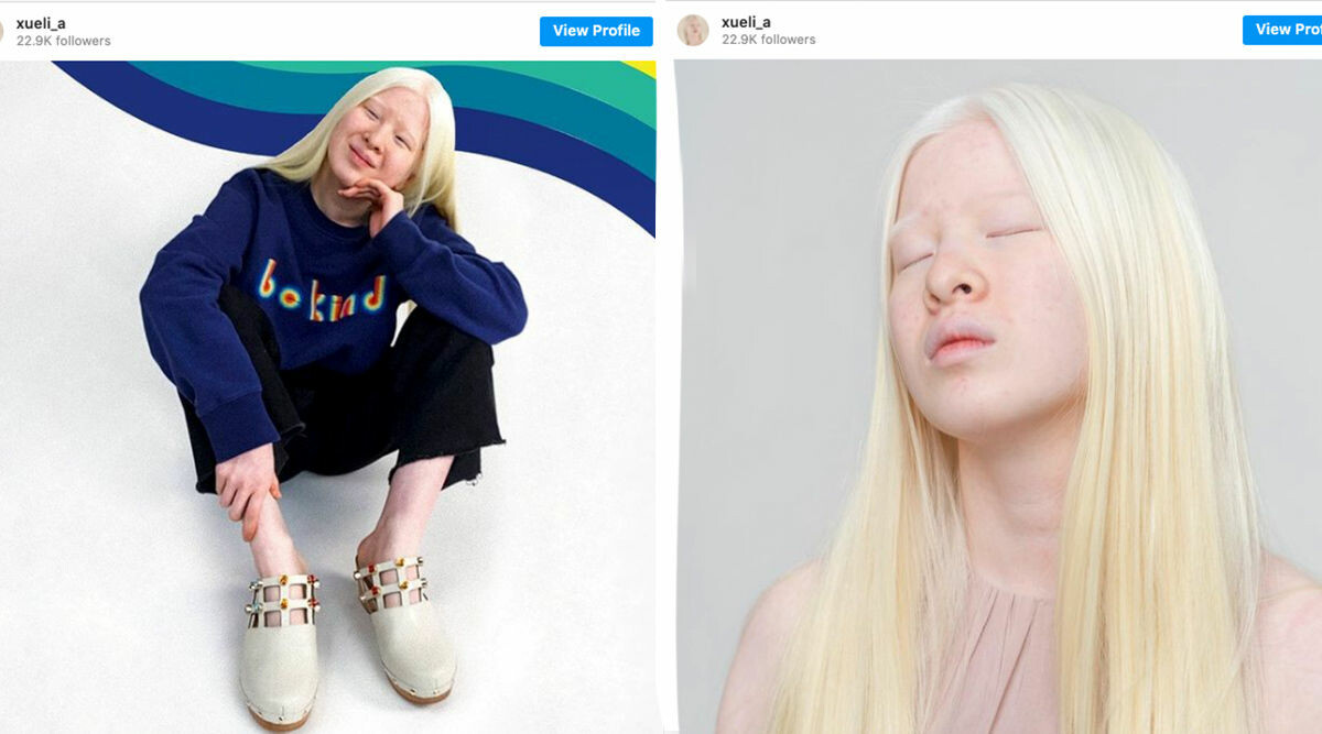 Hon övergavs av föräldrarna för att hon är albino – gör nu succé som modell