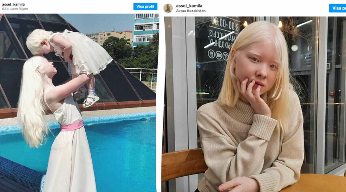 Båda systrarna är albino – nu gör de succé