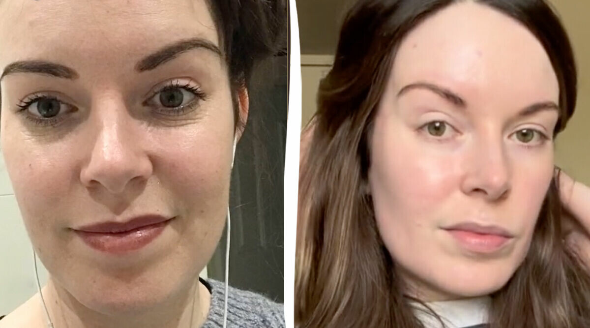 Främlingar tror jag använt botox – hyllar produkten från Apoteket