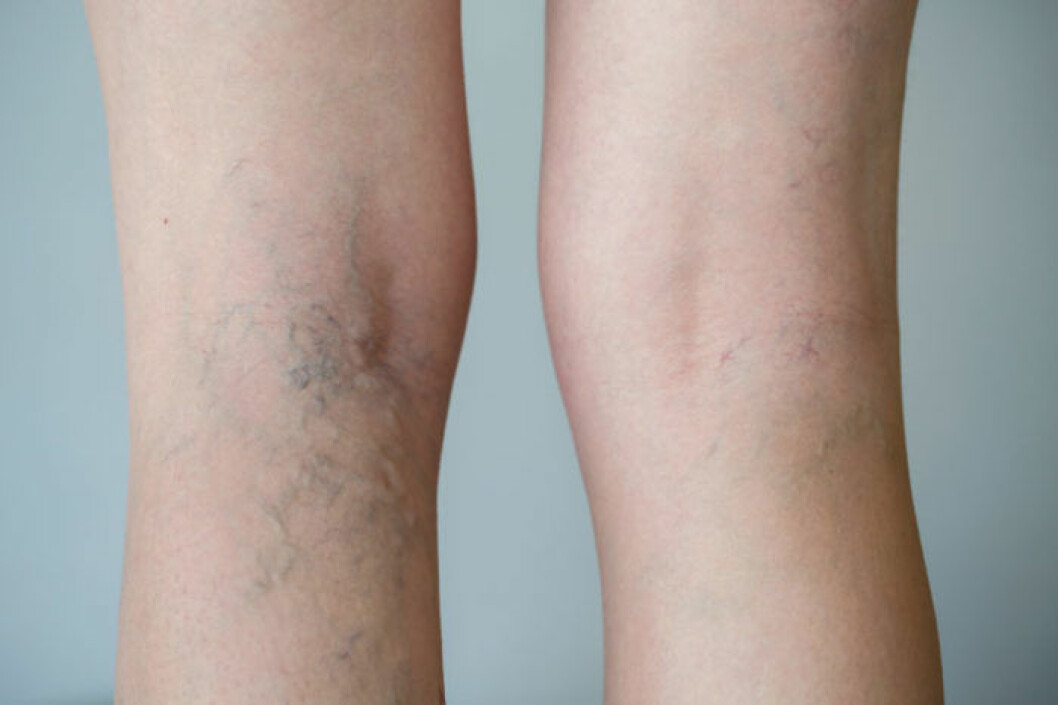 Åderbråck kan behandlas med hjälp av ingrepp eller injektioner, men oftast betalar inte landstinget eftersom det anses vara ett kosmetiskt ingrepp. Bild: Shutterstock/IBL Bildbyrå Åderbråck på ben.