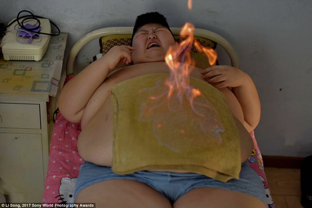 Den här pojken lades in på Cangchun weight loss centre förra året för att få traditionell kinesisk behandling. Bland annat eldterapi, som på bilden. Fotograf: Li Song