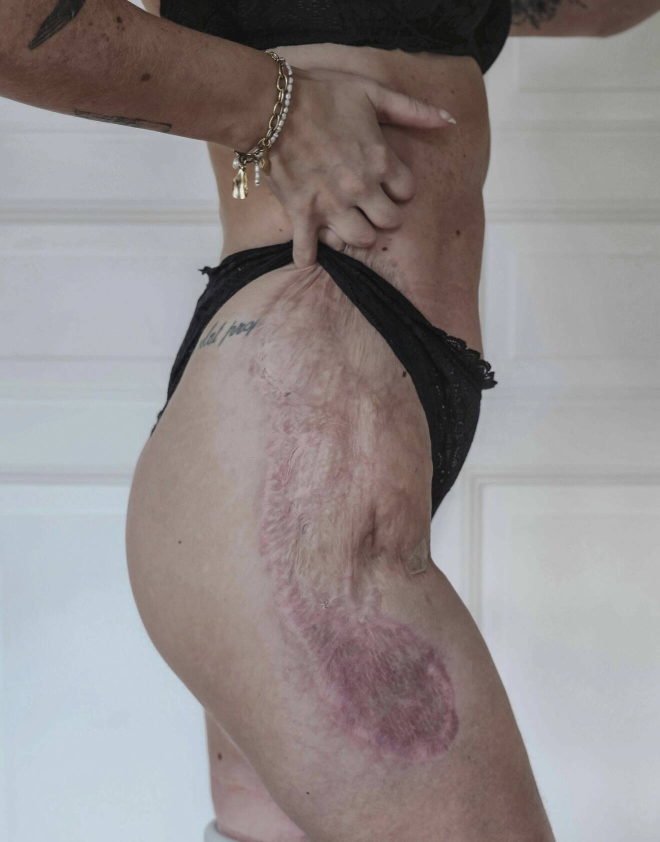 Elin Rantatalo tvingades transplantera hud från låret för att "täcka över" de delar av kroppen som drabbats hårt av vävnadsdöden efter sepsis.