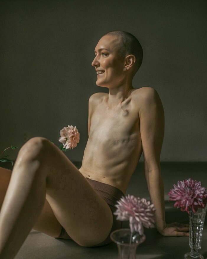 Emma Skoglund har mött olika reaktioner på att hon inte rekonstruerat sina bröst efter att ha drabbats av cancer.