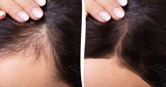 Håravfall kvinna som fått hårtillväxt
