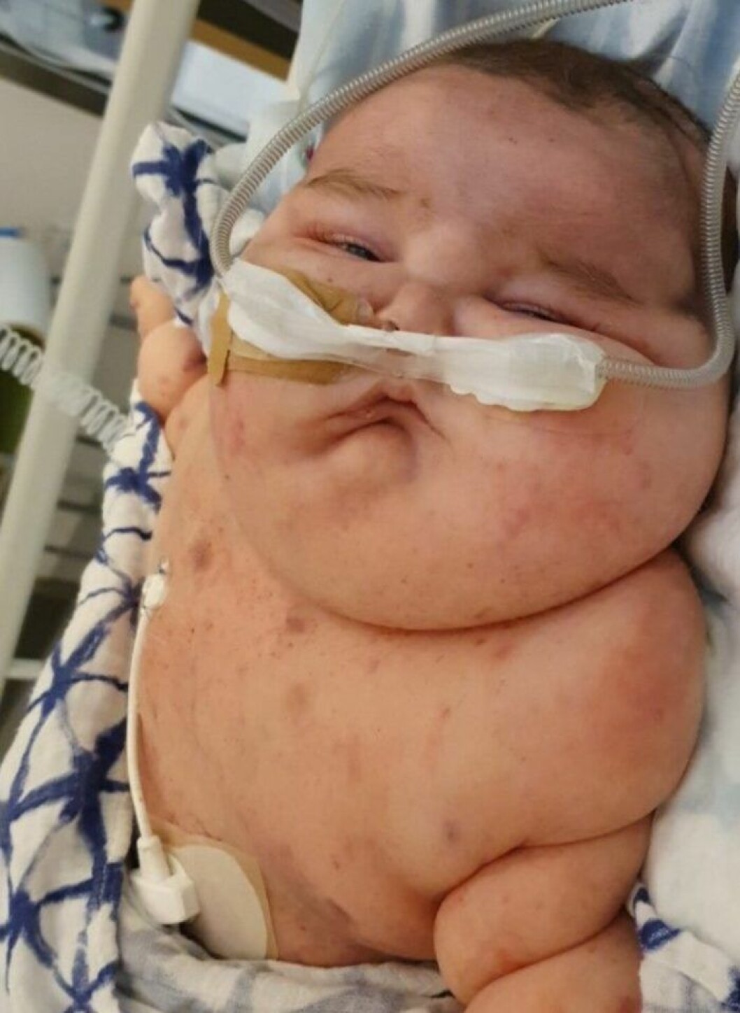 Walder fick mycket kortison under sin behandling, vilket gjorde att han svullnade upp i hela kroppen. Foto: Privat