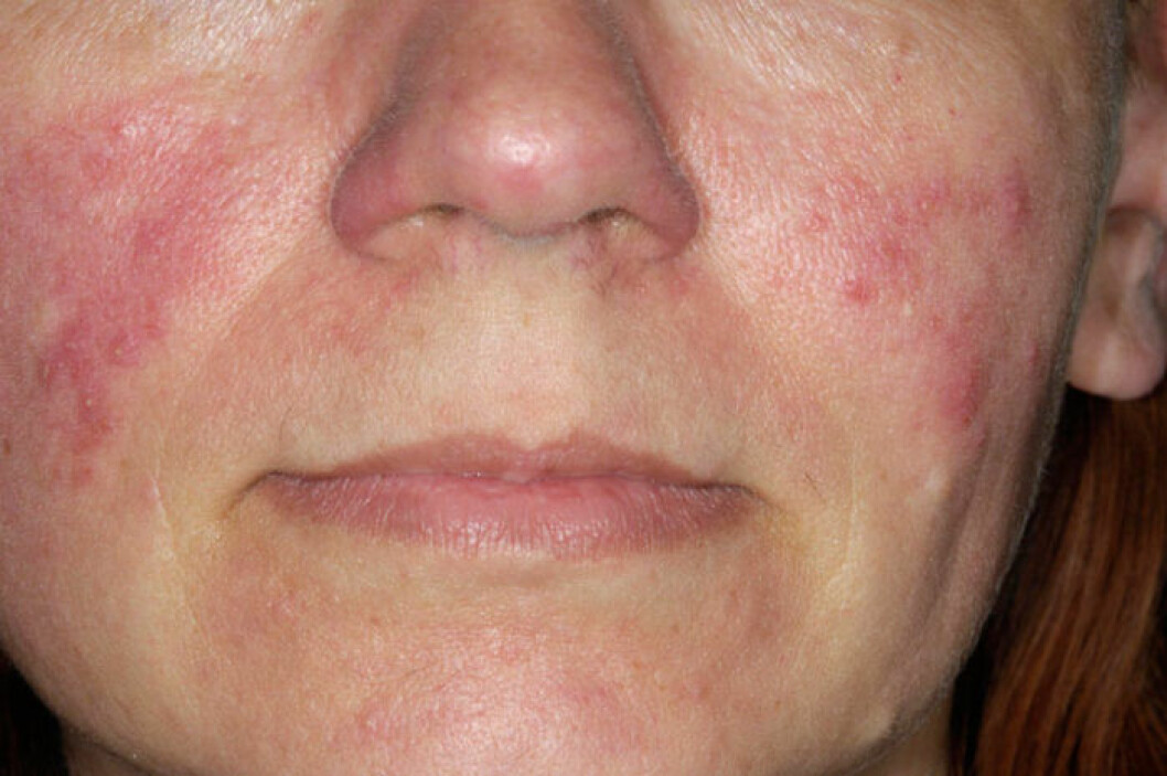 Rosacea drabbar mellan fem och tio procent av befolkningen, och något fler kvinnor än män. Bild: IBL Bildbyrå