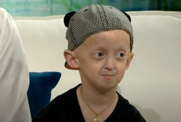 Miles är den enda i Sverige med sjukdomen Progeria.